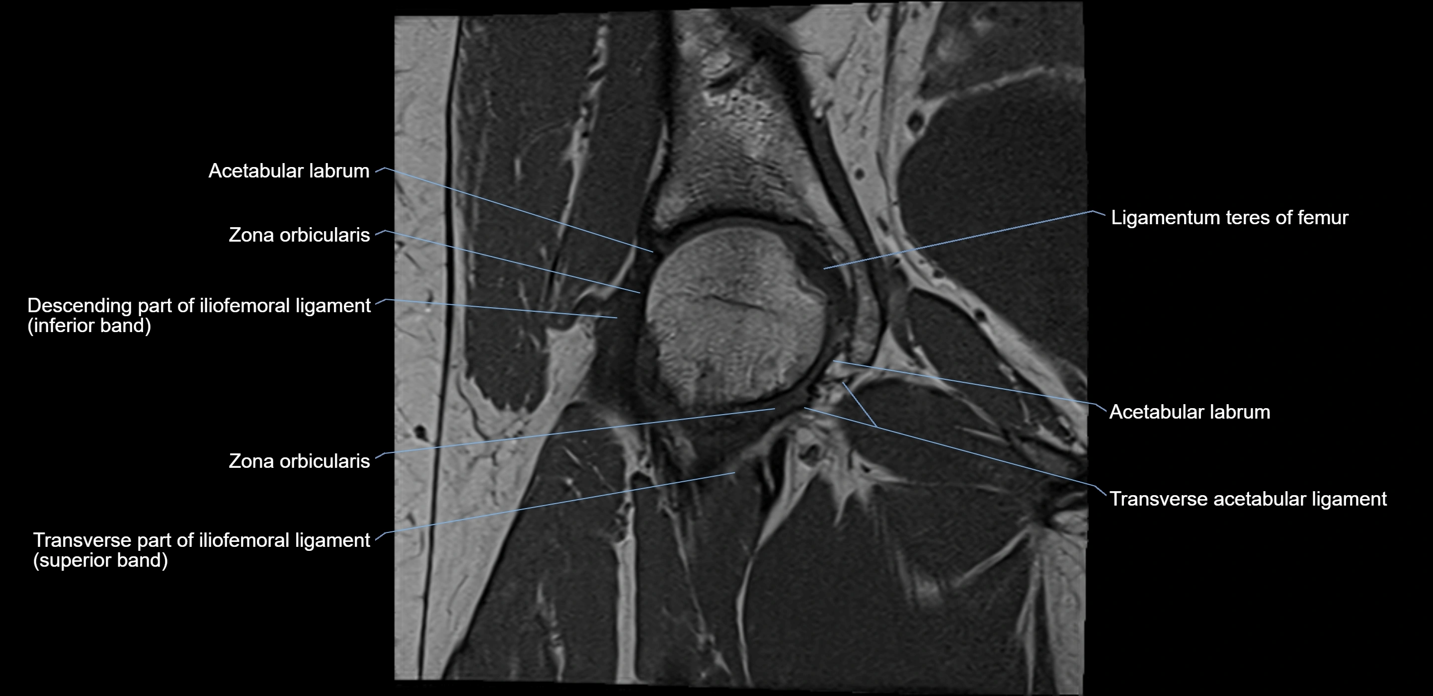 MRI Hip ligaments coronal cross sectional anatomy 3T  radiology  image-img-00001-00009.webp